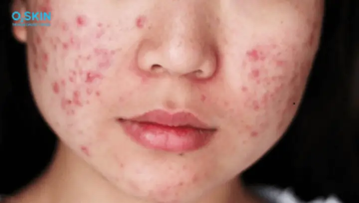 Hình Ảnh Trứng Cá Đỏ